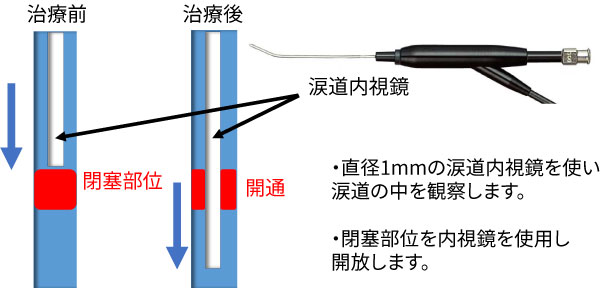 直径1㎜の涙道内視鏡を使い、涙道の中を観察します。閉塞部位を内視鏡を使用して開放します。