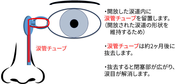 開放した涙道内に、開放された涙道の形状を維持するため涙管チューブを留置します。涙管チューブは2ヶ月後に抜去します。抜去すると閉塞部が広がり、涙目が解消します。